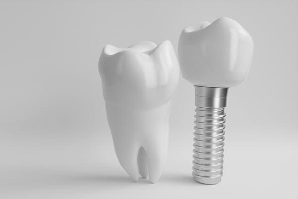 Implantes dentales