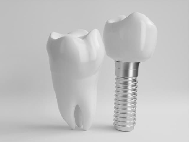 Implantes dentales en Santiago